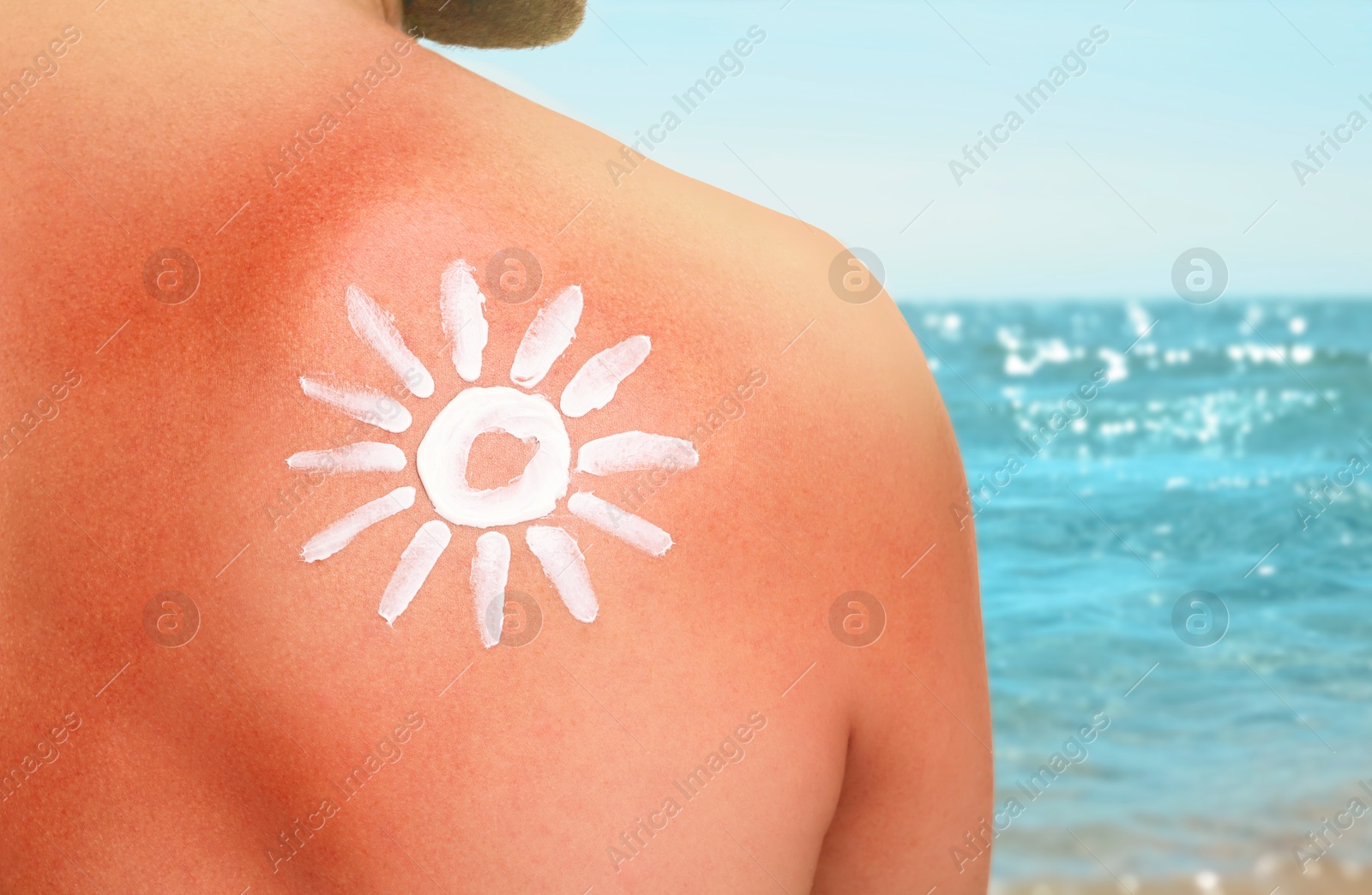 Man with sunburned skin on beach, back view. Soothing cream in shape of sun on his body Image of Man with sunburned skin on beach, back view. Soothing cream in shape of sun on his body