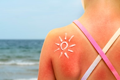 Image of Little girl with sunburned skin on beach, back view. Soothing cream in shape of sun on her body