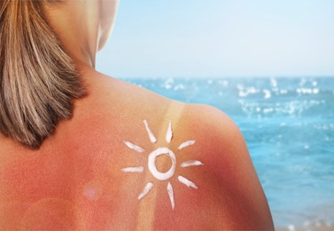 Image of Woman with sunburned skin on beach, back view. Soothing cream in shape of sun on her body