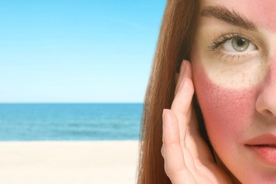 Image of Woman with sunburned skin on beach, closeup. Red face with marks from sunglasses