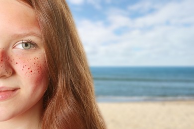 Image of Girl with sunburned skin on beach, closeup