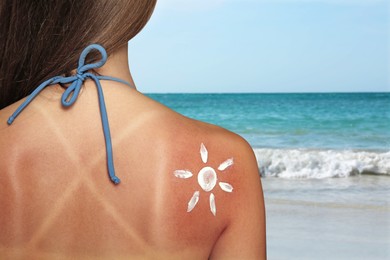 Image of Woman with sunburned skin on beach, back view. Soothing cream in shape of sun on her body