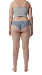 Photo of Liposuction. Woman in underwear on white background, back view