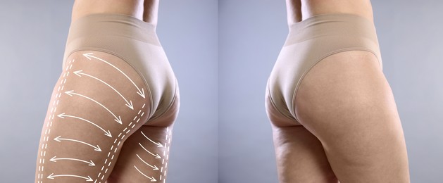 Image of Liposuction, collage. Woman showing her figure against grey background, closeup. Markings on her body