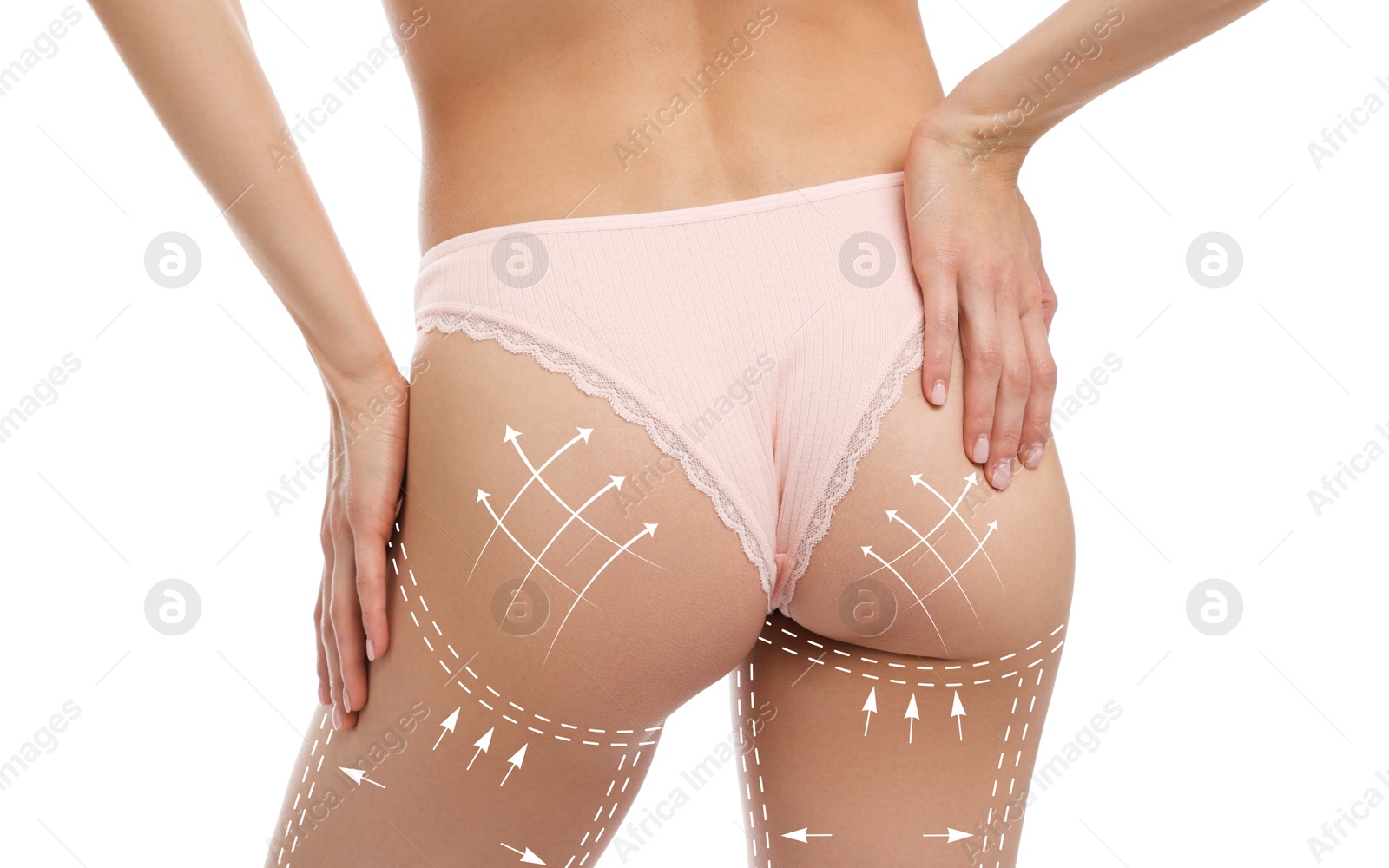 Image of Liposuction. Woman with perfect figure against white background, closeup. Markings on her body