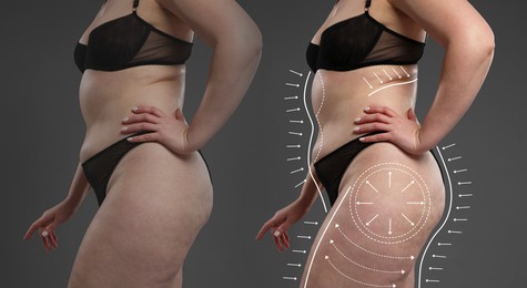 Image of Liposuction, collage. Woman with excessive fat against dark grey background, closeup. Markings on her body