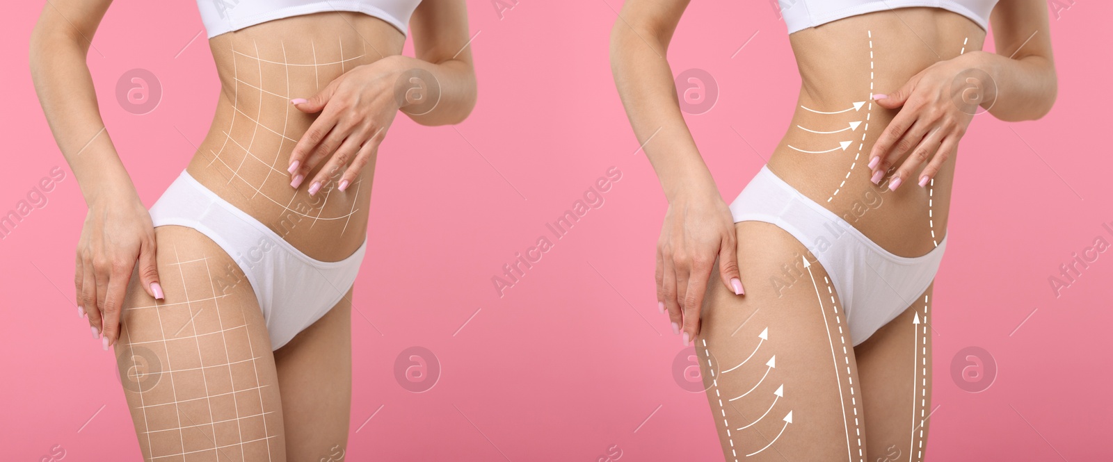 Liposuction, collage. Woman with perfect figure against pink background, closeup. Markings on her body Image of Liposuction, collage. Woman with perfect figure against pink background, closeup. Markings on her body