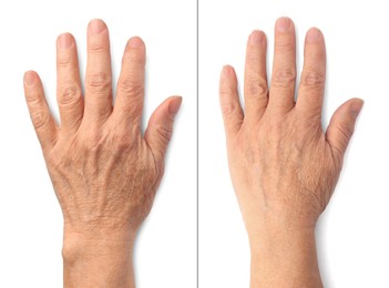 Image of Ageing skin. Woman's hand on white background, closeup. Collage showing difference in texture