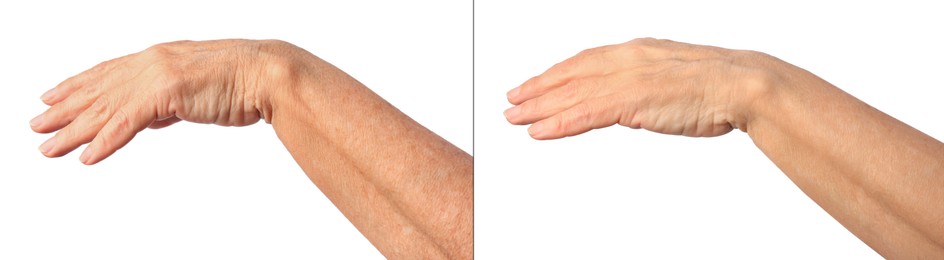 Image of Ageing skin. Woman's hand on white background, closeup. Collage showing difference in texture
