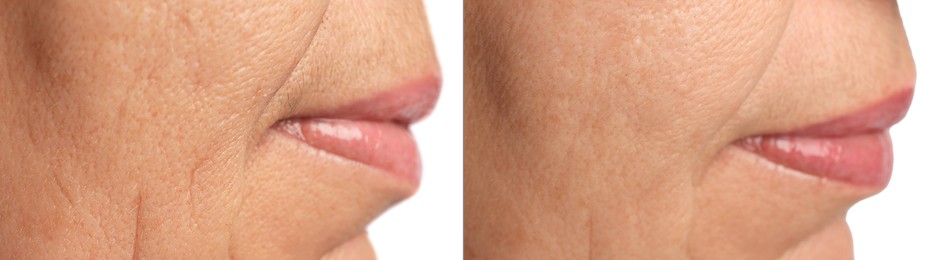 Image of Ageing. Photos of woman's face, closeup of lower part. Collage showing difference in skin texture