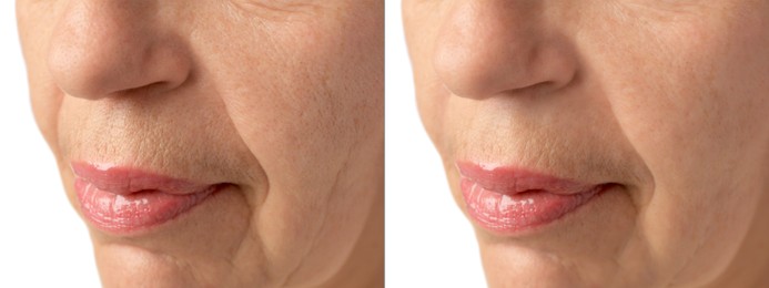 Image of Ageing. Photos of woman's face, closeup of lower part. Collage showing difference in skin texture