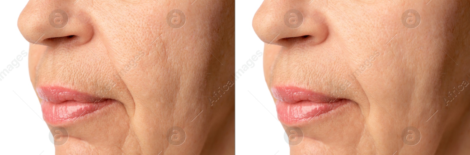 Image of Ageing. Photos of woman's face, closeup of lower part. Collage showing difference in skin texture