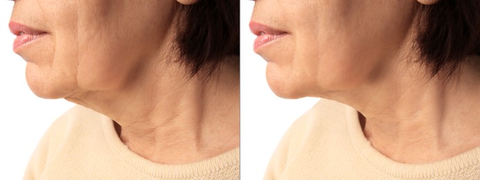 Image of Ageing. Photos of woman's face, closeup of lower part. Collage showing difference in skin texture