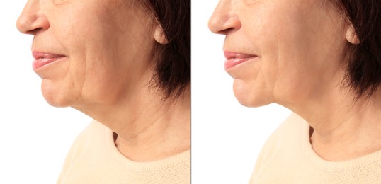 Image of Ageing. Photos of woman's face, closeup of lower part. Collage showing difference in skin texture