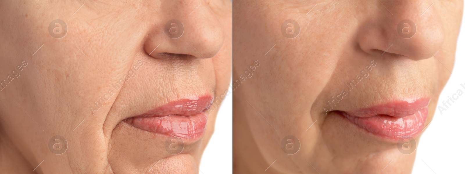 Image of Ageing. Photos of woman's face, closeup of lower part. Collage showing difference in skin texture