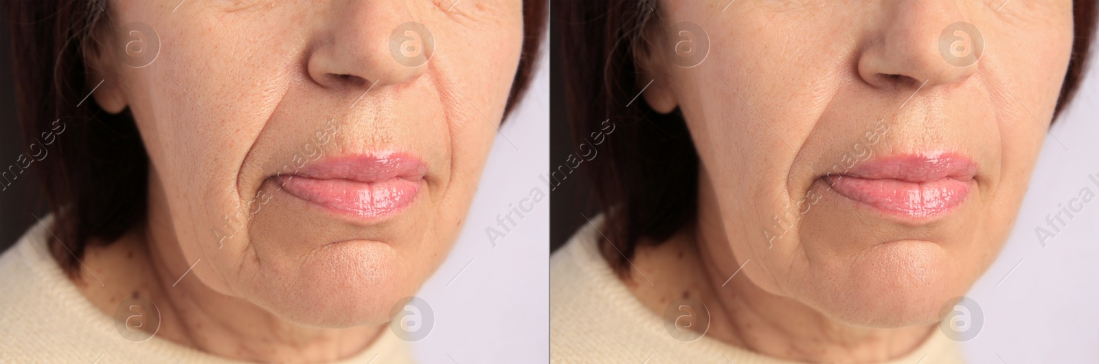 Image of Ageing. Photos of woman's face, closeup of lower part. Collage showing difference in skin texture