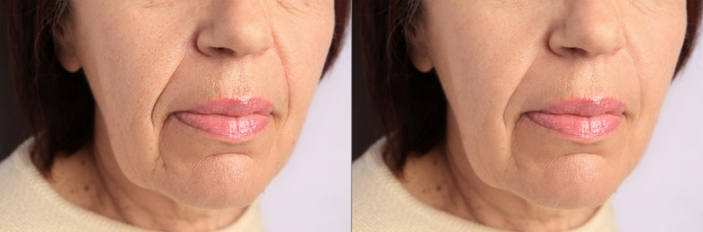 Image of Ageing. Photos of woman's face, closeup of lower part. Collage showing difference in skin texture