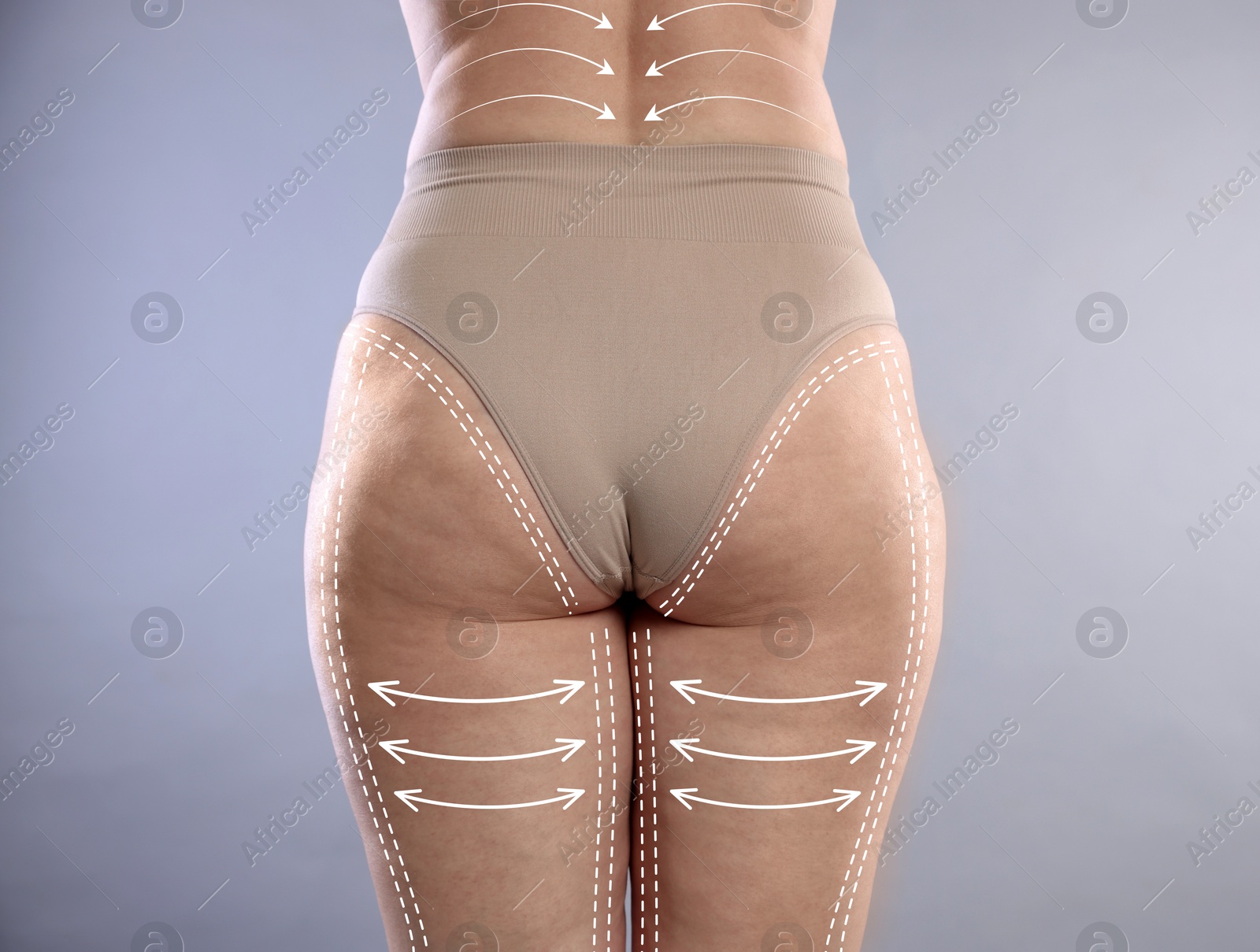 Liposuction. Woman showing her figure against grey gradient background, closeup. Markings on her body Image of Liposuction. Woman showing her figure against grey gradient background, closeup. Markings on her body