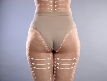 Image of Liposuction. Woman showing her figure against grey gradient background, closeup. Markings on her body
