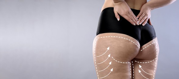 Image of Liposuction. Woman showing her figure against grey gradient background, closeup. Markings on her body