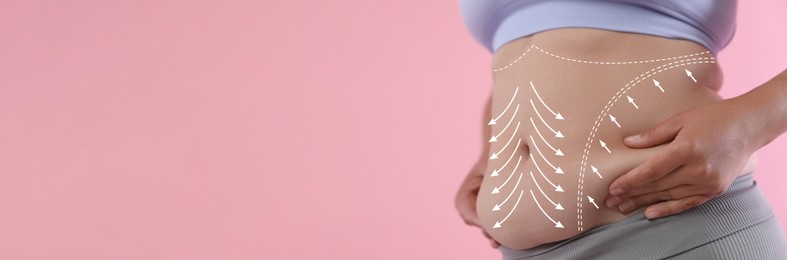 Image of Liposuction. Woman showing excessive belly against pink background, closeup. Markings on her body
