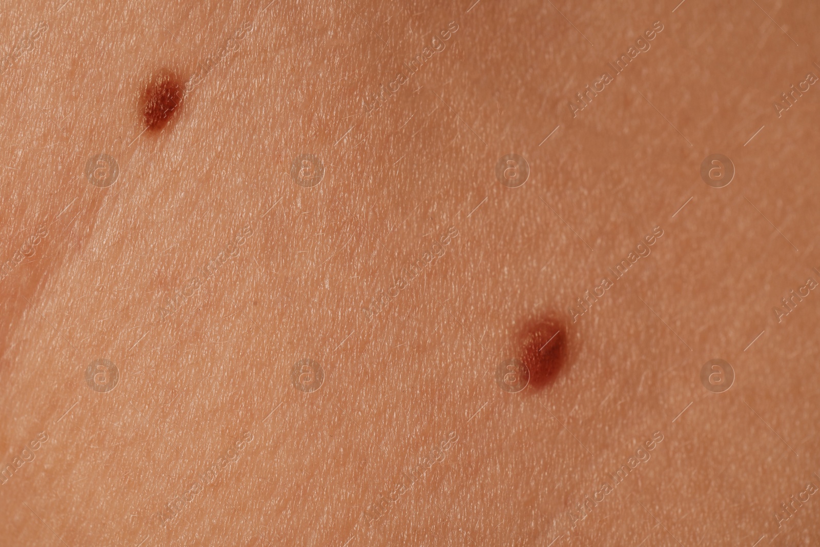 Photo of Woman with moles on her body, closeup