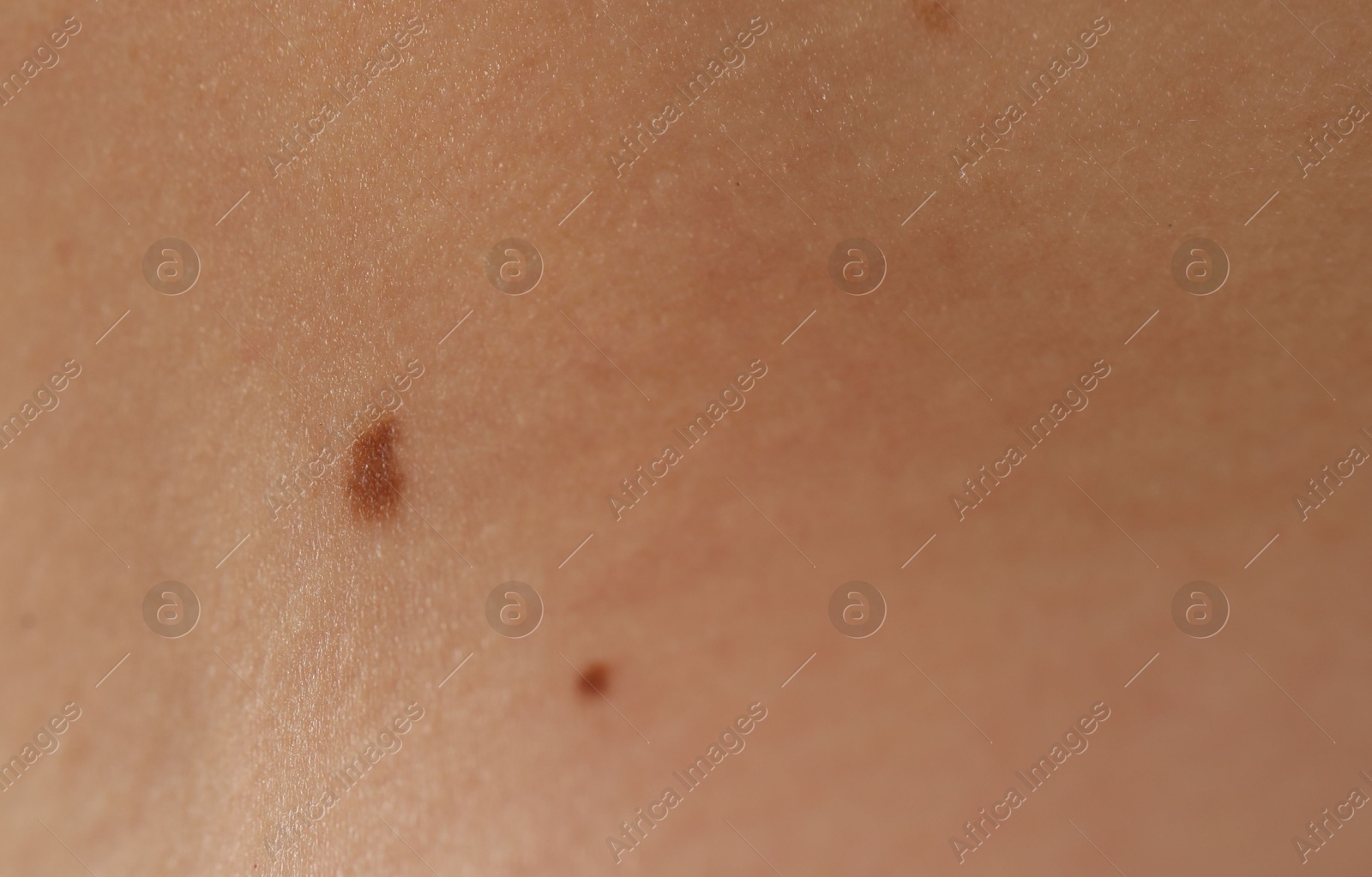 Photo of Woman with moles on her body, closeup