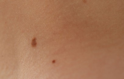 Photo of Woman with moles on her body, closeup