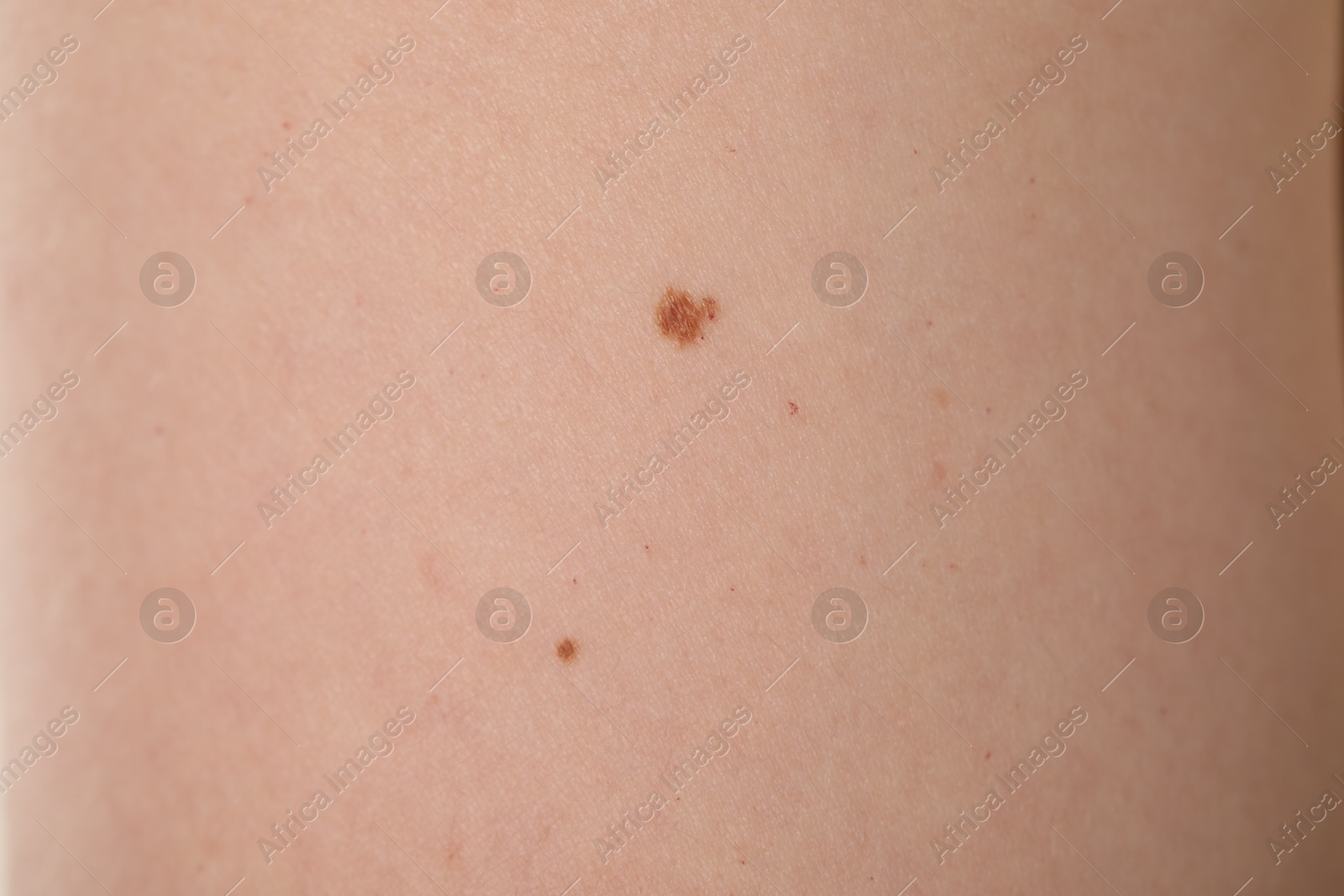 Woman with moles on her body, closeup Photo of Woman with moles on her body, closeup