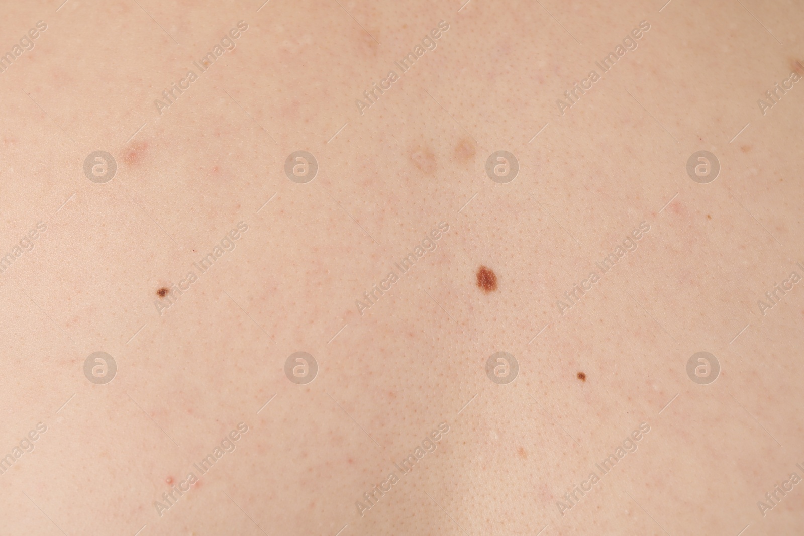 Woman with moles on her body, closeup Photo of Woman with moles on her body, closeup