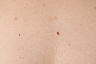 Photo of Woman with moles on her body, closeup