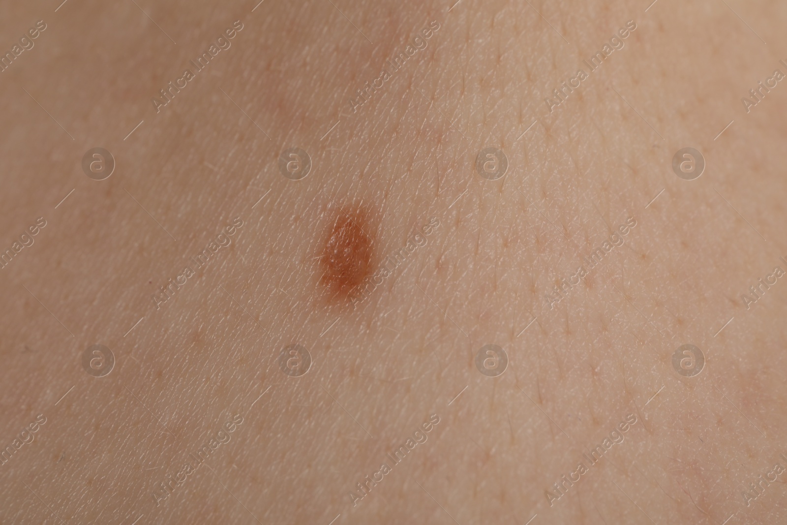Woman with mole on her body, closeup Photo of Woman with mole on her body, closeup