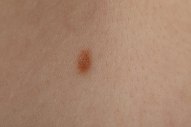 Photo of Woman with mole on her body, closeup