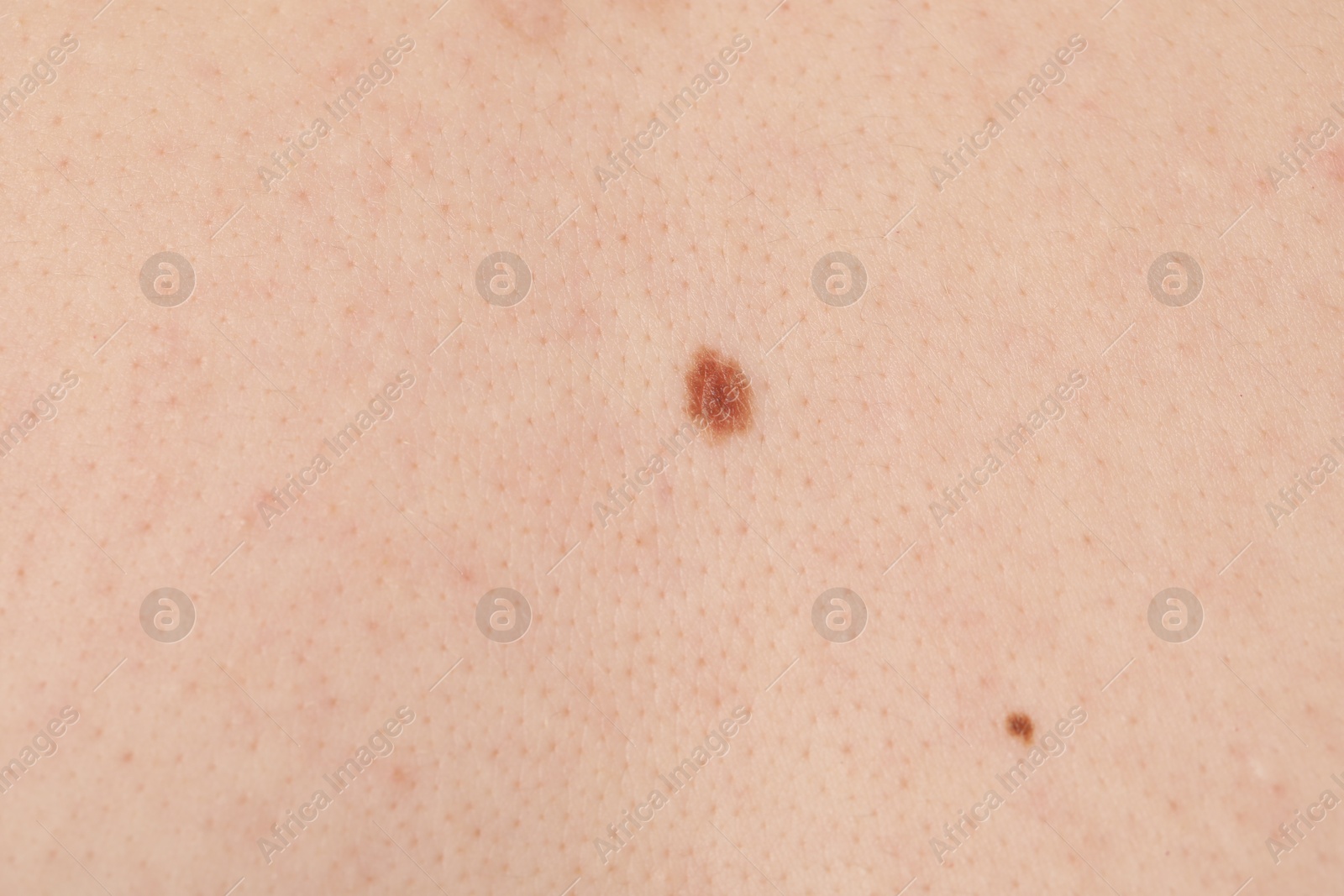 Woman with moles on her body, closeup Photo of Woman with moles on her body, closeup
