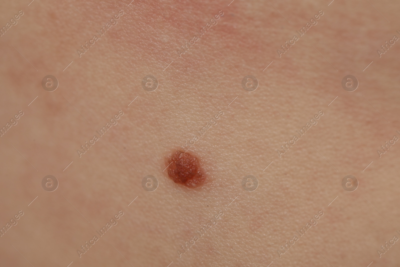 Woman with mole on her body, closeup Photo of Woman with mole on her body, closeup