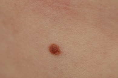 Photo of Woman with mole on her body, closeup