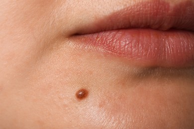 Photo of Woman with mole on her face, closeup