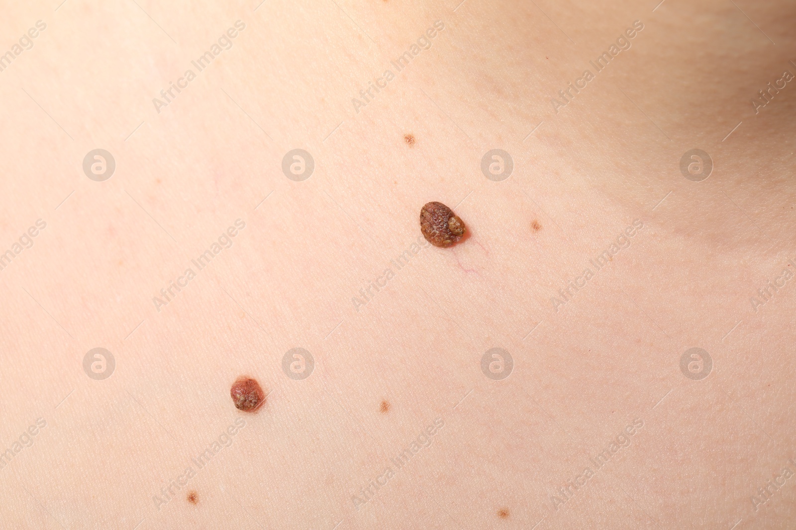 Woman with moles on her body, closeup Photo of Woman with moles on her body, closeup