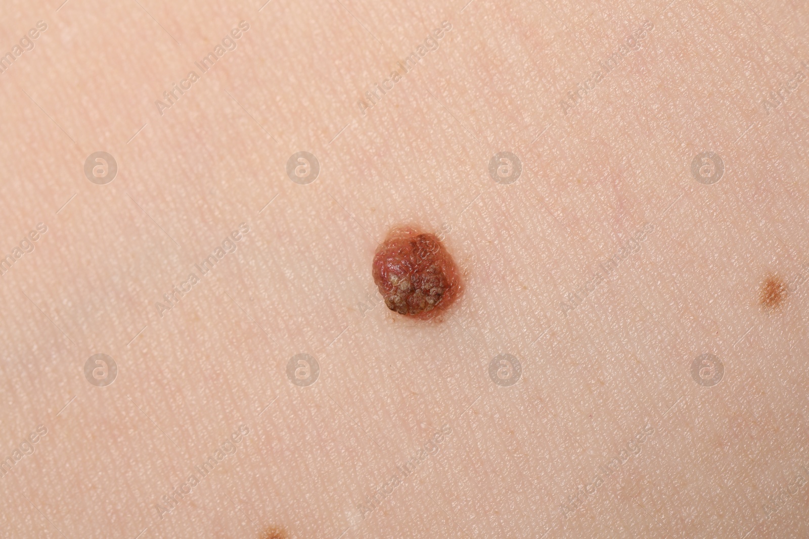 Woman with moles on her body, closeup Photo of Woman with moles on her body, closeup