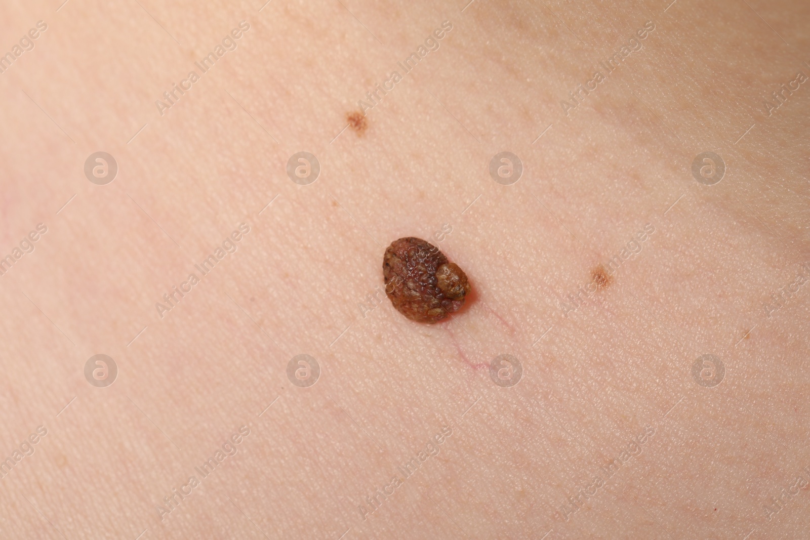Woman with moles on her body, closeup Photo of Woman with moles on her body, closeup