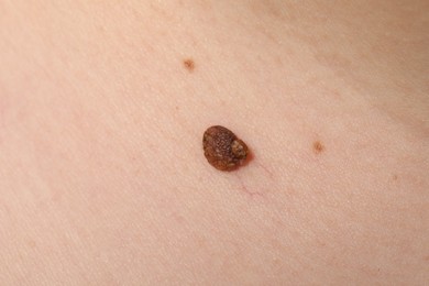 Photo of Woman with moles on her body, closeup