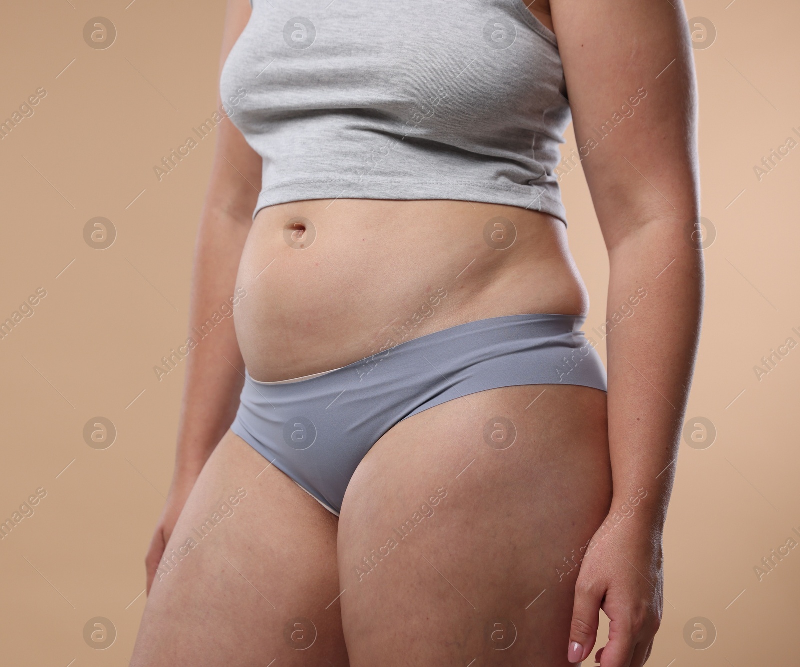 Liposuction. Woman in underwear on beige background, closeup Photo of Liposuction. Woman in underwear on beige background, closeup