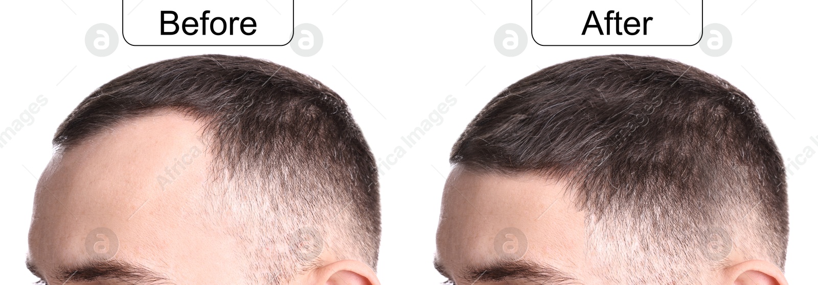 Image of Man before and after hair treatment on white background, collage