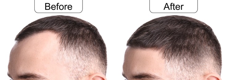 Image of Man before and after hair treatment on white background, collage