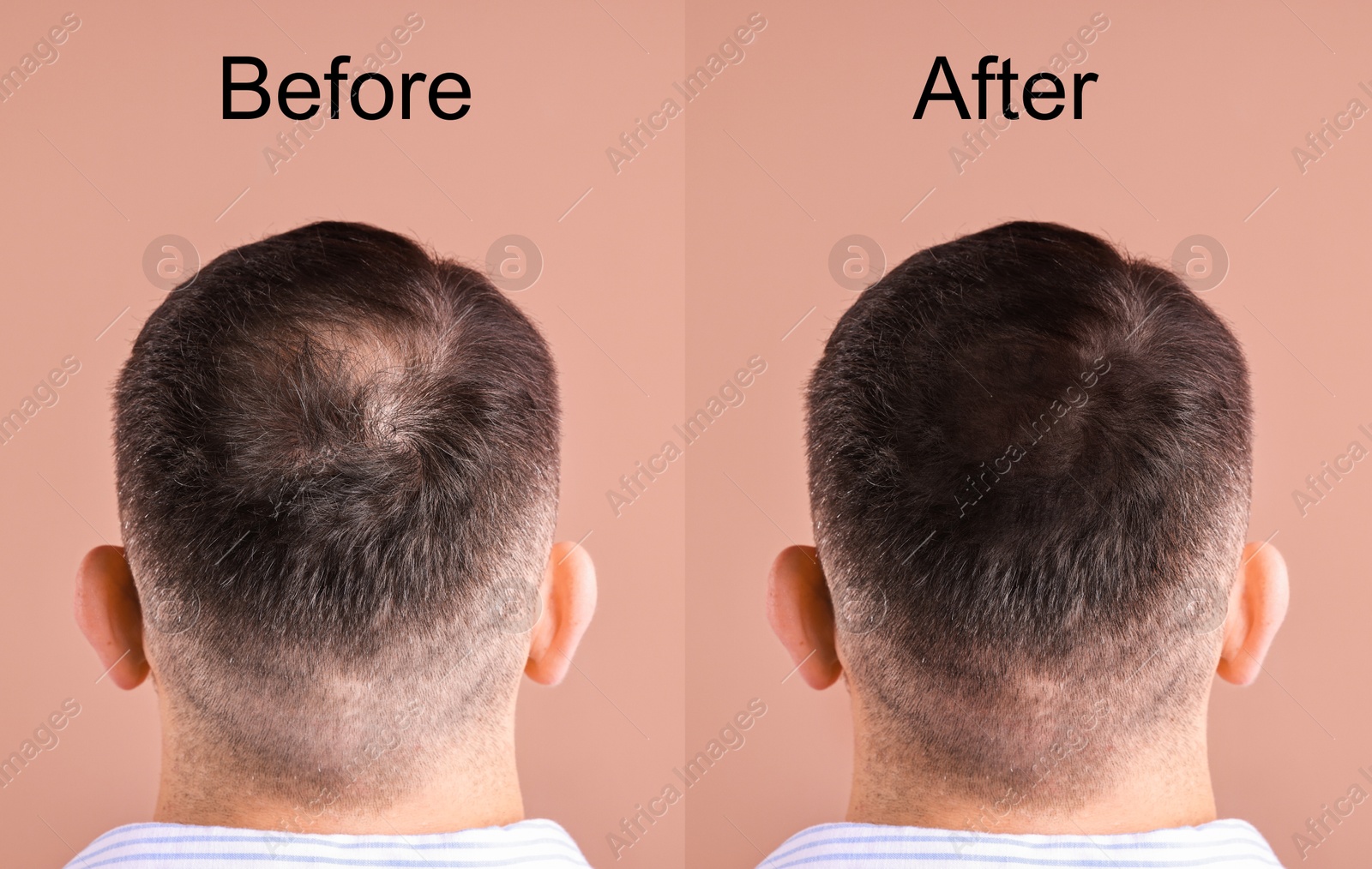 Image of Man before and after hair treatment on beige pink background, collage. Back view