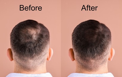 Image of Man before and after hair treatment on beige pink background, collage. Back view