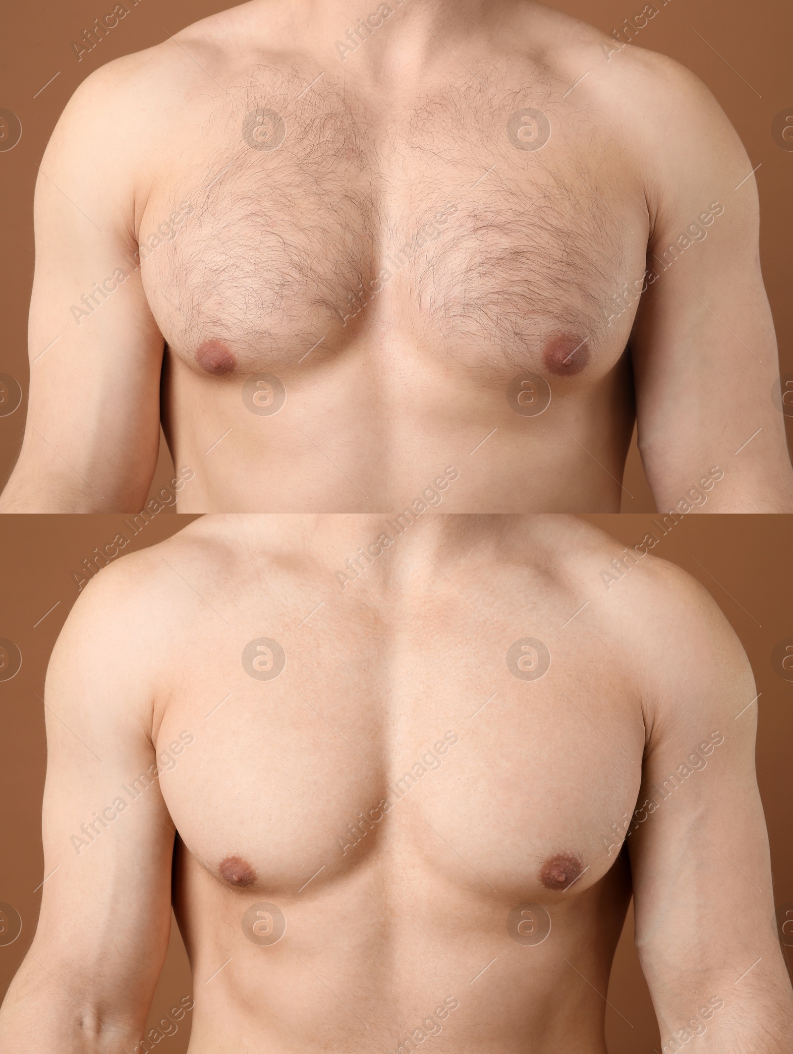 Image of Man before and after hair removal procedure, closeup. Collage showing hairy and smooth chest