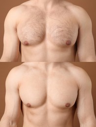 Image of Man before and after hair removal procedure, closeup. Collage showing hairy and smooth chest