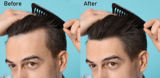 Image of Man before and after hair treatment on light blue background, collage