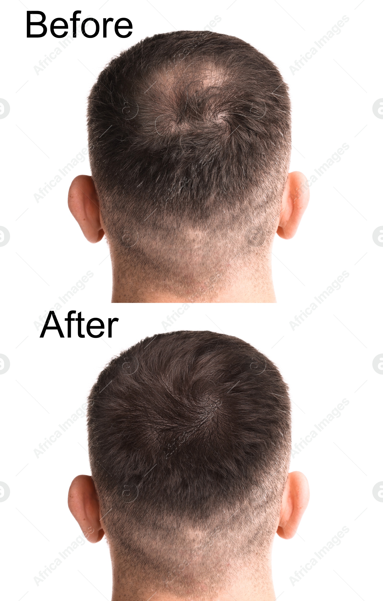 Image of Man before and after hair treatment on white background, collage. Back view